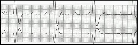 Third degree heart block is a type of atrioventricular (av) block in which electrical signals are blocked between the atria (top chambers) and ventricles (bottom chambers). Float Nurse: Practice Rhythm Strips 301