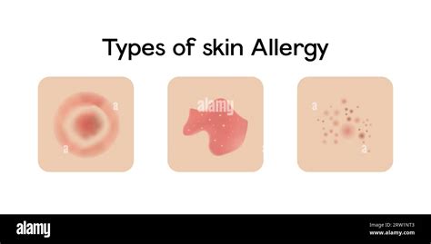 Types Of Skin Allergy Vector Illustration Design Stock Vector Image And Art Alamy