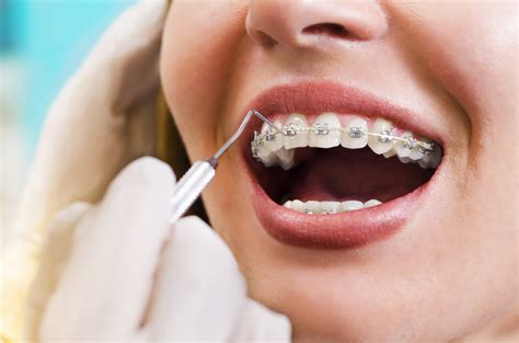 Braces Elastics Must Read Guide Dental Aware Australia