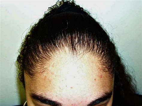 The patient notes this lesion trichoscopy (hair and scalp dermoscopy) can be used to further evaluate areas of hair loss and in cases of trichotillomania will most likely show irregularly. Derm Dx: Hair loss in a 15-year-old female - Clinical Advisor