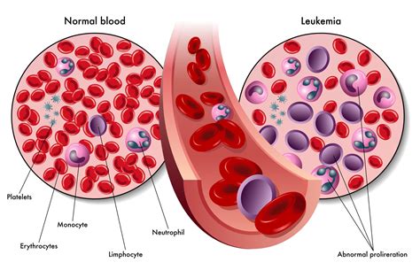 Cancer Ganglios Linfaticos Sintomas Seo Positivo