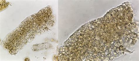Mixed Cellular Casts On Urine Microscopy Degenerating Grepmed