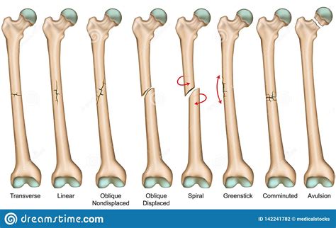 Types Of Bone Fractures Medical Educational Vector