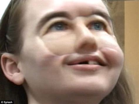 Prosthetic Face Allows Mother Disfigured In Shooting To Play With Son Without Mask For First