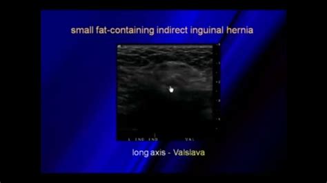 Ultrasound Of Hernias Education Ultrasound Pandora Screenshot