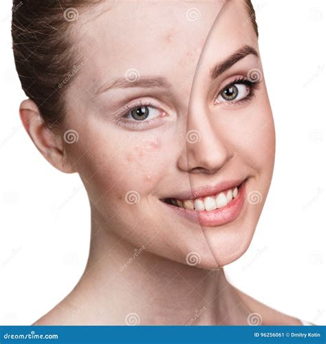 dziewczyna z trądzikiem przed i po traktowaniem obraz stock obraz złożonej z pozaziemski
