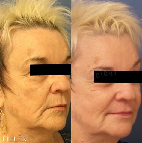 Before After Gallery La Jolla Archives Torrey Pines Dermatology
