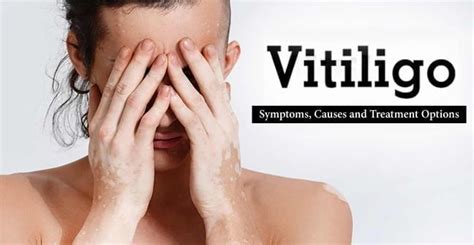 Vitiligo Symptoms Causes And Treatment Options
