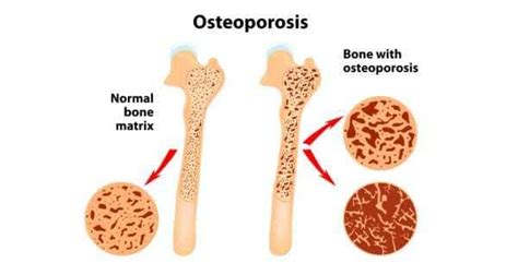 Osteoporosis Treatment Osteoporosis Symptoms