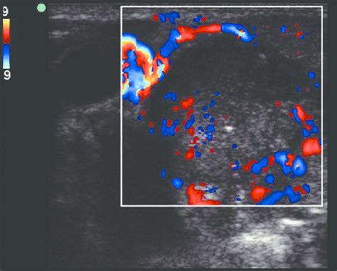 Cervical Lymph Nodes Ultrasound