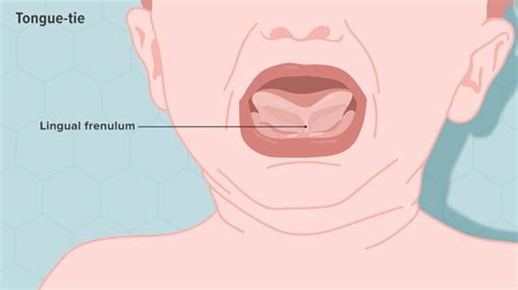 Tongue And Lip Ties What Should I Know Wheeler Pediatric Dentistry