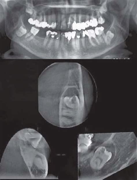 Follicular Cyst And Impacted Lower Wisdom Tooth Extension