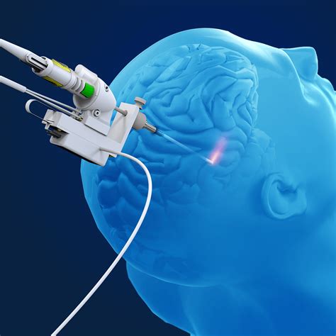 The NeuroBlate Laser Ablation System Monteris