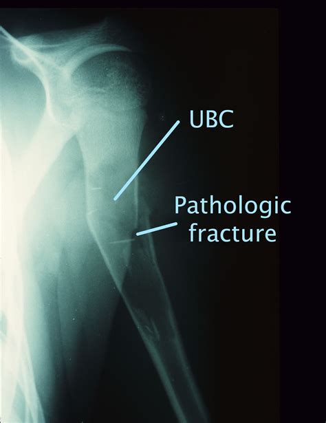 Unicameral Bone Cysts Orthoinfo Aaos
