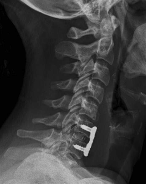 chirurgiavertebrale.it: controllo rx frattura-lussazione ...