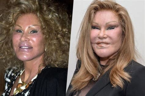 Hollywood Top Stars Celebrity Faces Plastic Surgery How Can Done