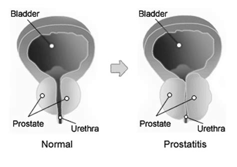 Prostatitis Treatment Acute And Chronic Prostatitis