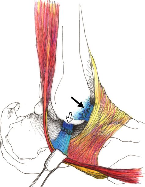 Imaging Appearances Of Lateral Ankle Ligament Reconstruction