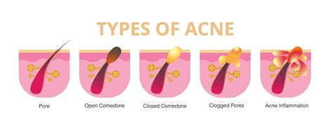 Acne Stages Of Developmenthealthy Skinvector Design 24515366 Vector