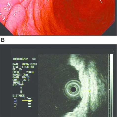 Pdf A New Method Of Endoscopic Ultrasonography For Determining Lesion