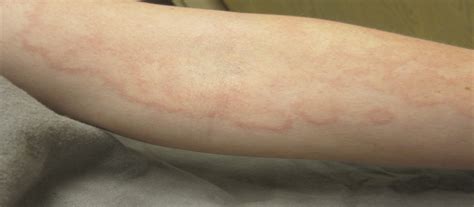 Erythema Multiformelike Allergic Contact Reaction To Topica