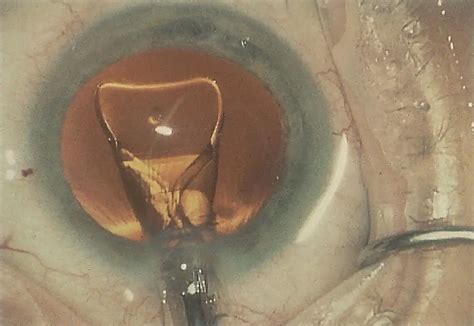 Foldable Plate Haptic Iol American Academy Of Ophthalmology