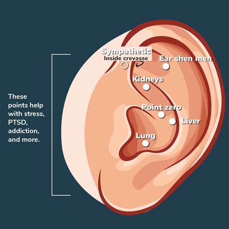 Acupuncture Ear Seed Demo Nada Protocol Aligned Modern Health