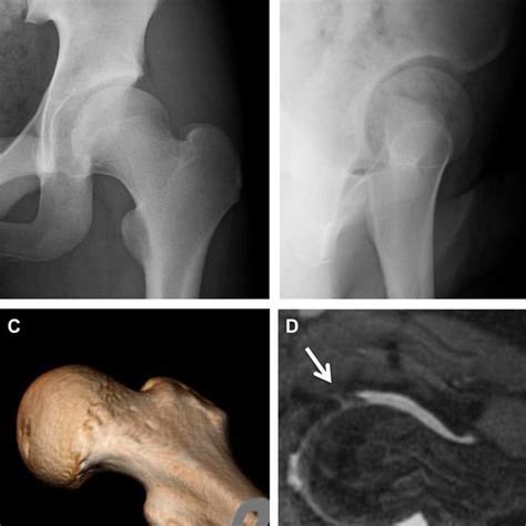 A Diagnostic Preoperative Anteroposterior Pelvic Radiograph Of