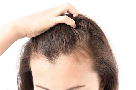 Psoriasis Of The Scalp Can It Be Treated And Cured
