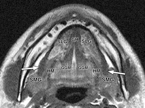 Imaging Of The Mylohyoid Muscle Separation Of Submandibular And