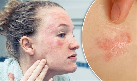 Get Rid Of Eczema On The Face Fast Home Remedies Neck Naturally