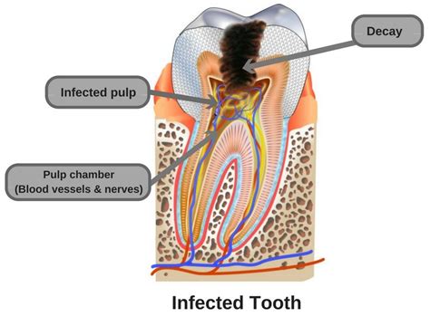 cavities form  teeth science abc
