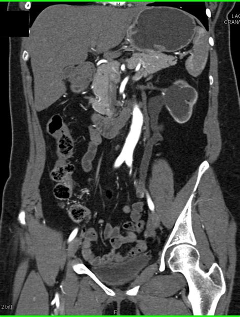 Transitional Cell Cancer Tcc Left Distal Ureter Genitourinary Case