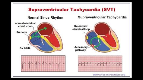 Olivia Health Video Presentation Supraventricular Tachycardia Svt My
