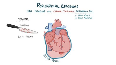 Pericardial Tamponade What Is It Causes Pericardial Effusion Signs Porn Sex Picture