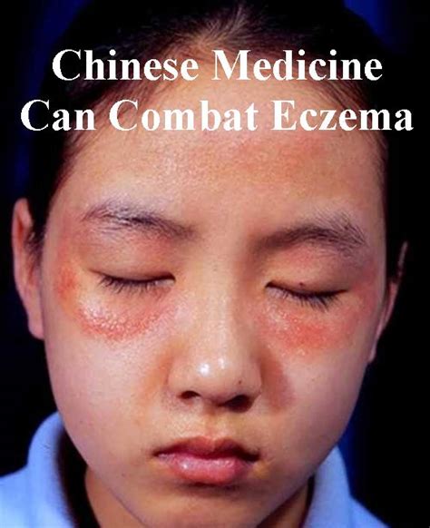 Eczema Tcm Houston Acupuncture And Herbs