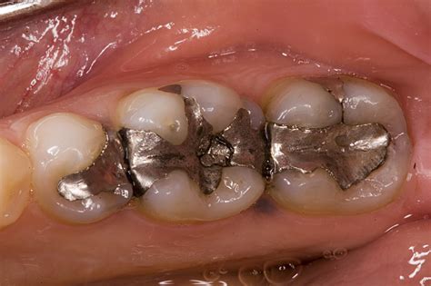 Amálgama Dentária Dicas De Saúde