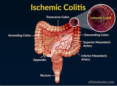Colitis Ischemic Causes Symptoms Pain Pathophysiology Colon