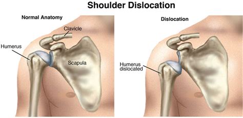 This section of the website will explain large. What is Shoulder Dislocation and Instability ? - Sports ...