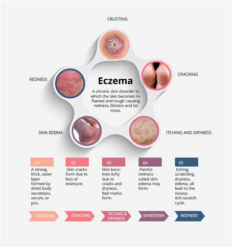 Atopic Dermatitis Eczema Infographic Interesting Facts 2019
