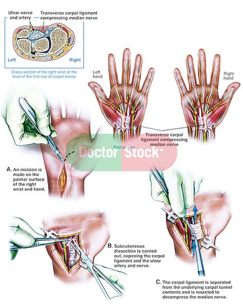 Bilateral Carpal Tunnel Syndrome And Surgical Repair Doctor Stock