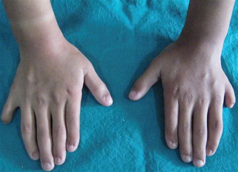 Hands Revealing Postaxial Polydactyly Download Scientific Diagram