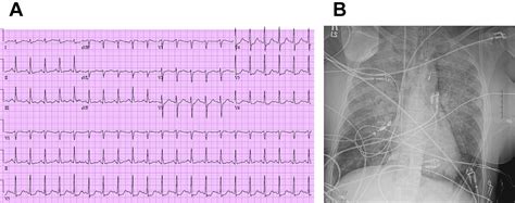 Cardiogenic Shock Critical Care Clinics