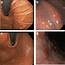 Endoscopic Images Of Atrophic Gastritis By White Light And Narrow Band 