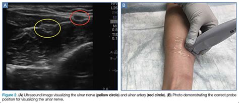 Emergency Ultrasound Ultrasound Guided Ulnar Median And Radial Nerve