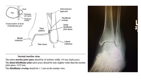 Ankle Mortise View Diagram Diagnosis Radiology Grepmed