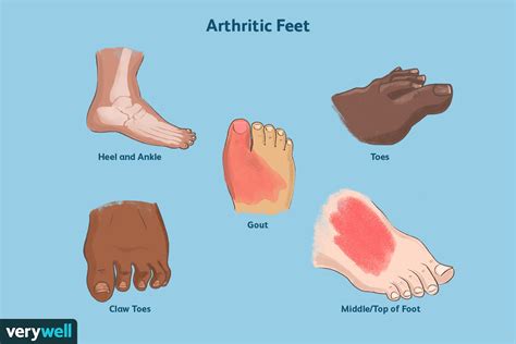 The Small Toe Is Medial To The Big Toe