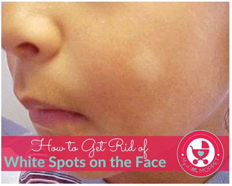 White spots on face what s causing it. 5 ways to get rid of white spots on the face of your child ...