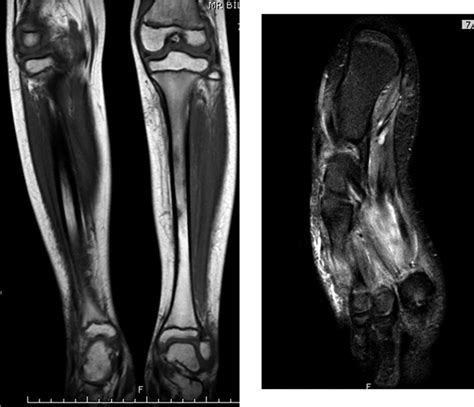 Mri Of The Lower Extremities Shows Edema Within The