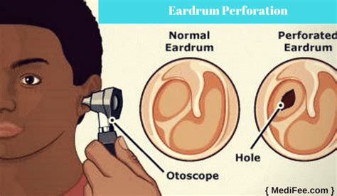 Eardrum Repair Surgery